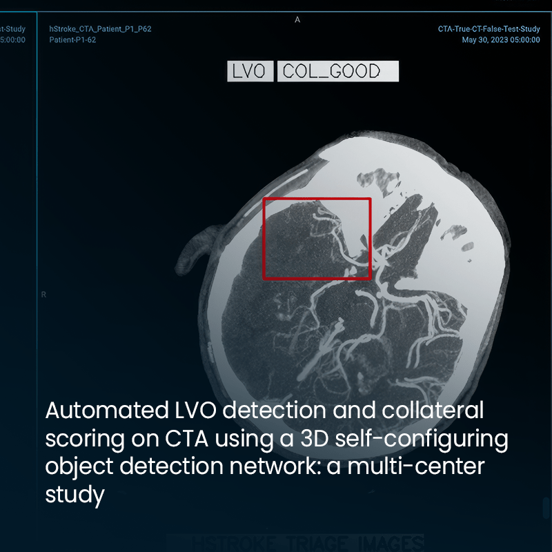  Revolutionary AI Model Enhances LVO Detection and Collateral Scoring in Stroke Patients