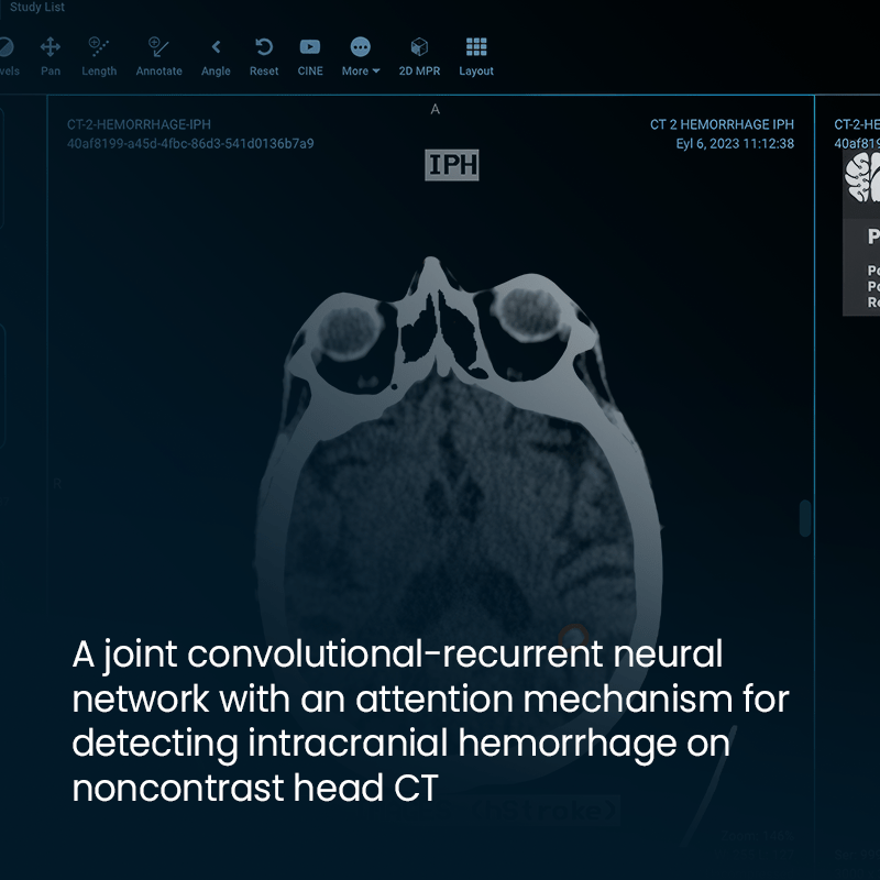 Groundbreaking Study on AI-Enhanced Detection of Intracranial Hemorrhage