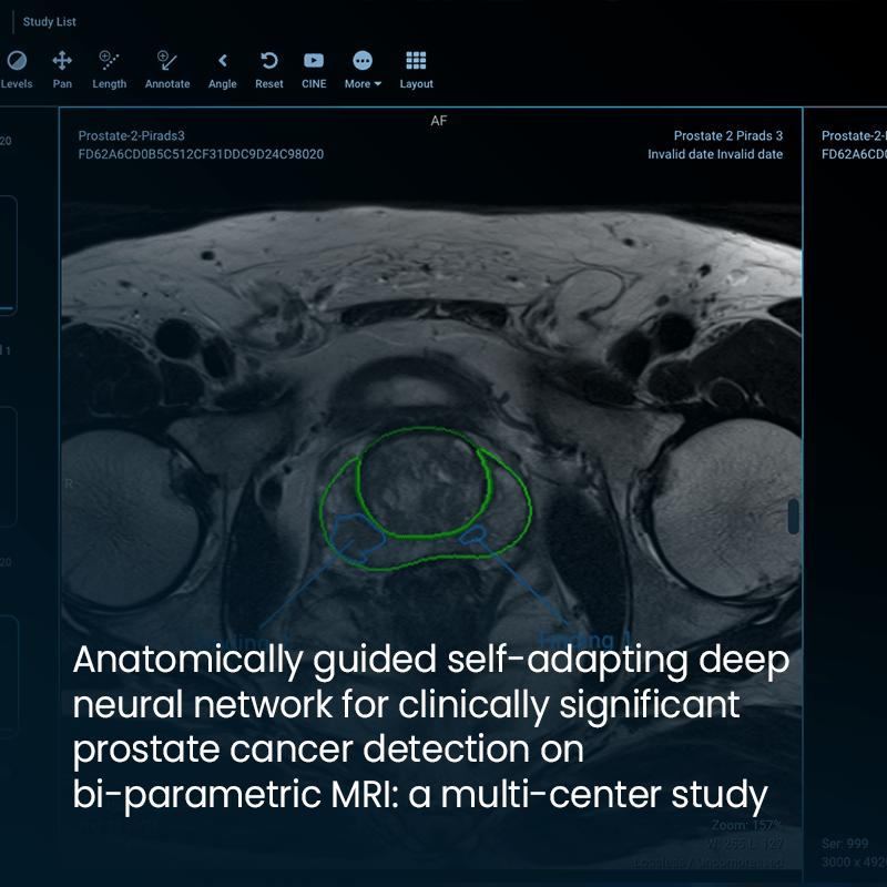 Advancements in Prostate Cancer Detection with Self-Adapting Deep Neural Networks